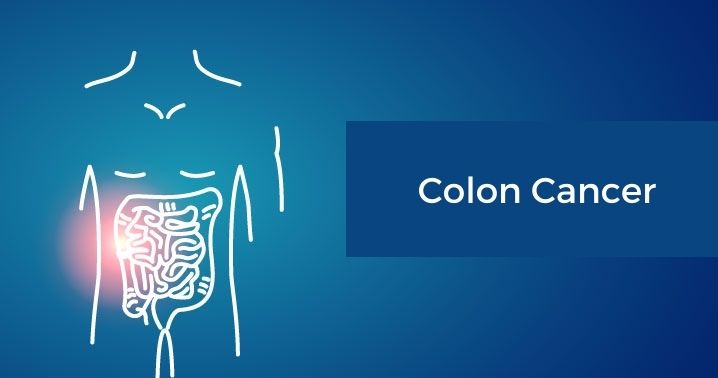 Colon Cancer