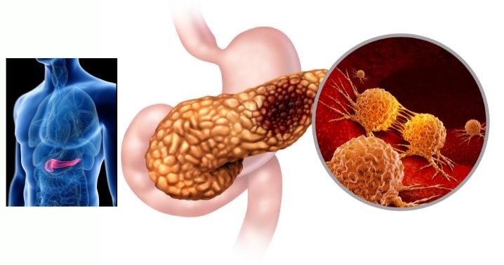 Pancreatic Cancer